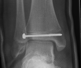 Tillaux Fracture ORIF